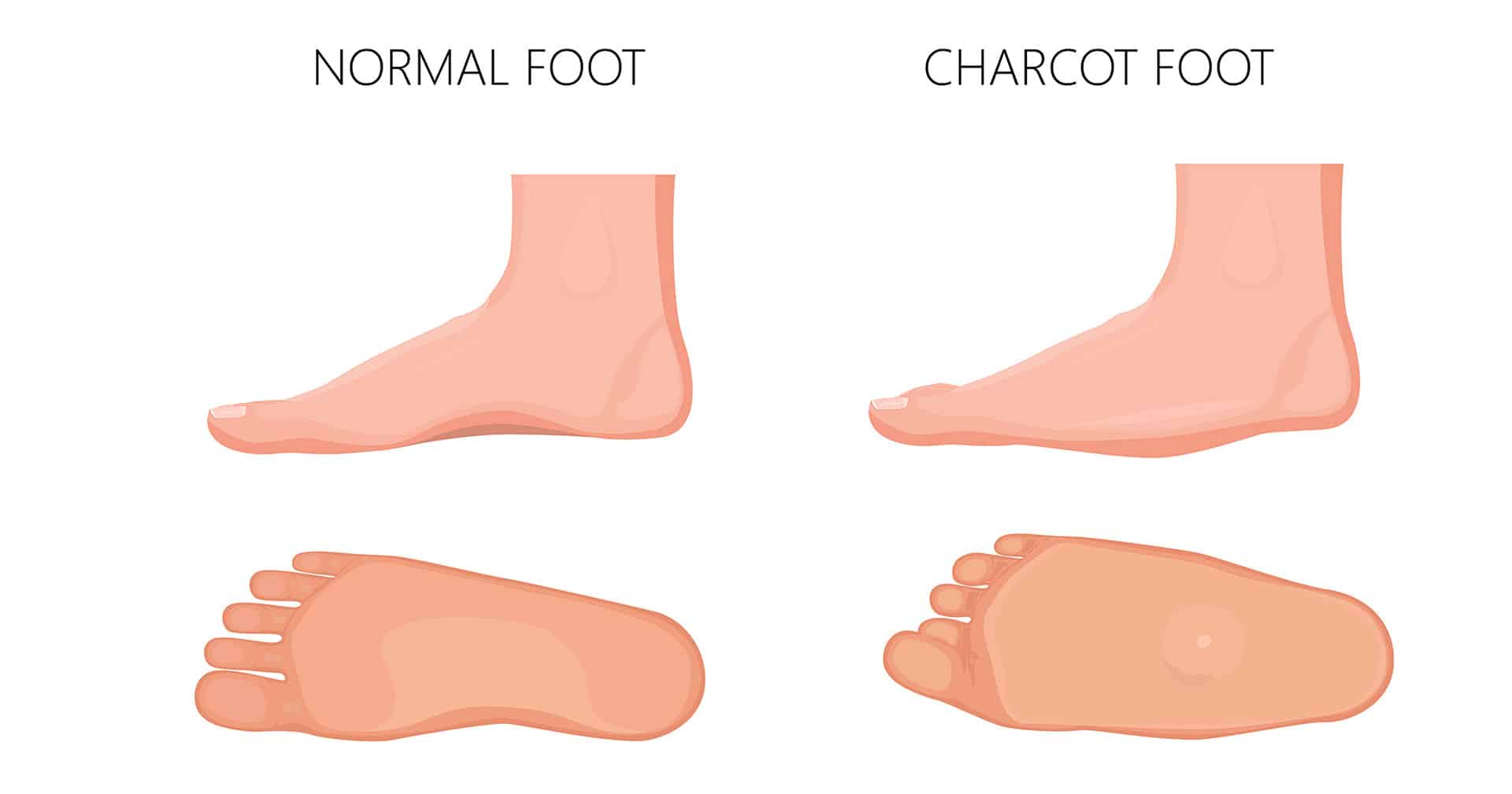 Diabetes Charcot Foot Syndrome - Foot Health Clinic Samford Village QLD