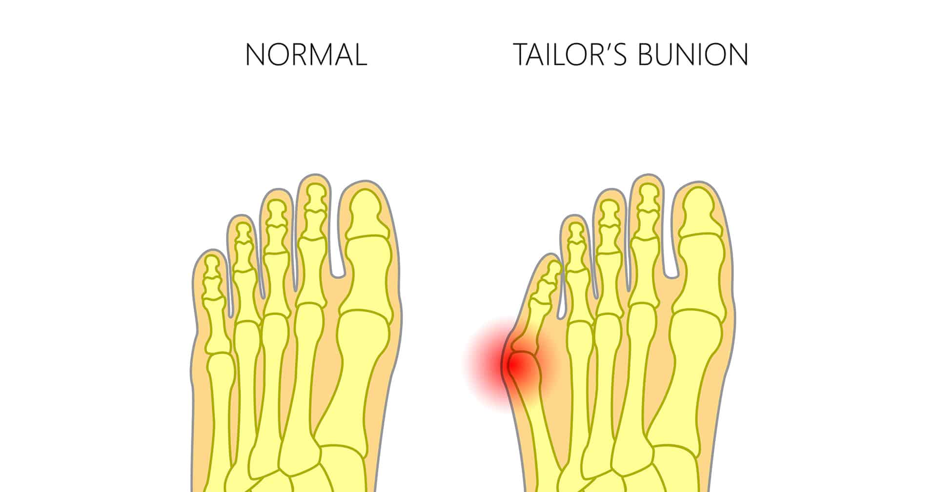 Foot Posture and Gait Disorders Brisbane | Brisbane North Clinic