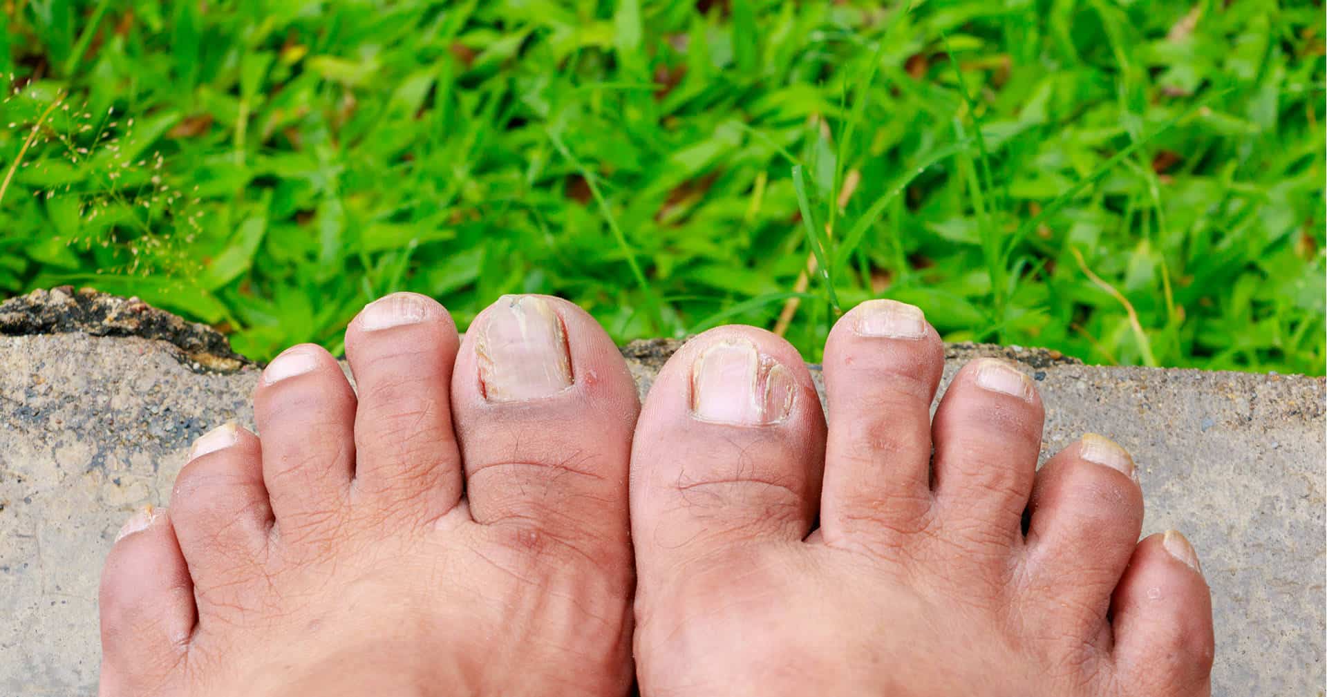 Длинные грязные ногти на ногах