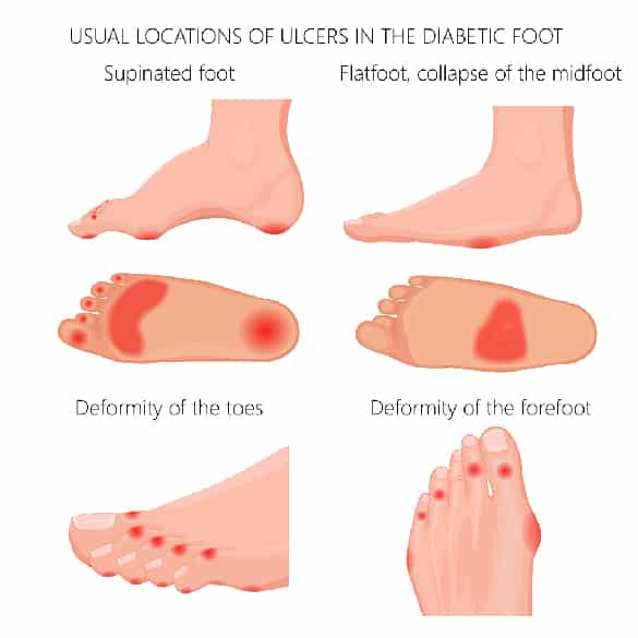 diabetic foot diagram