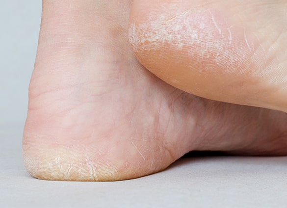 Foot Rest - Looking to get rid of dry, cracked skin on... | Facebook