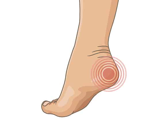 Heel Pain and Spurs | Foot and Ankle Specialists